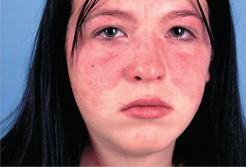 Systemic Lupus Erythematosus (SLE)