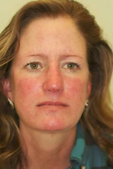 Rosacea Redness