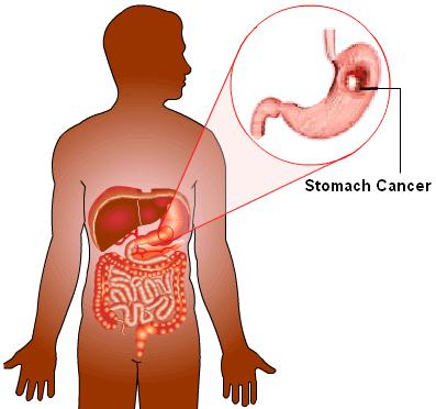 learn about the Stages of Stomach Cancer