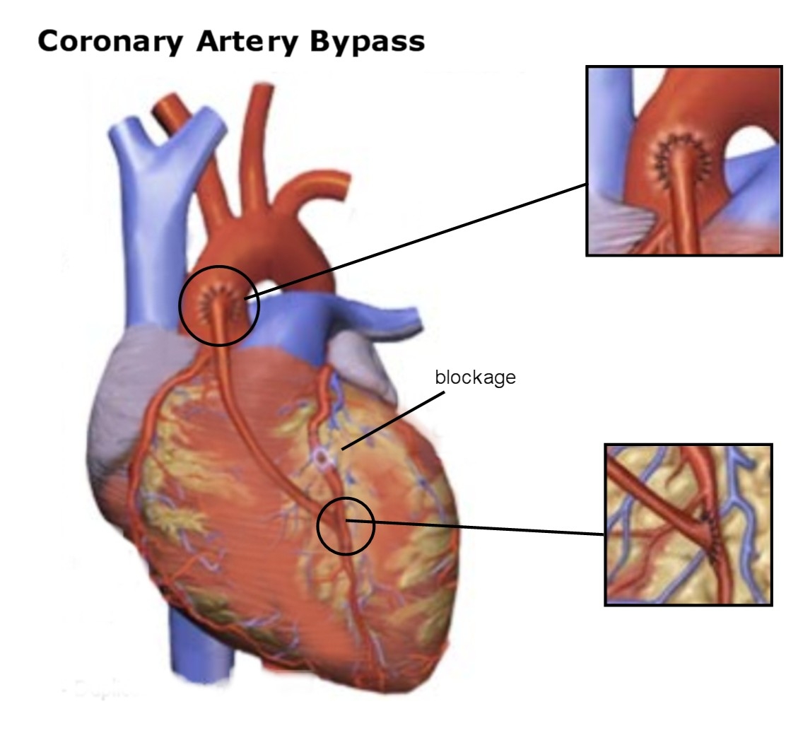 Coronary Artery Bypass