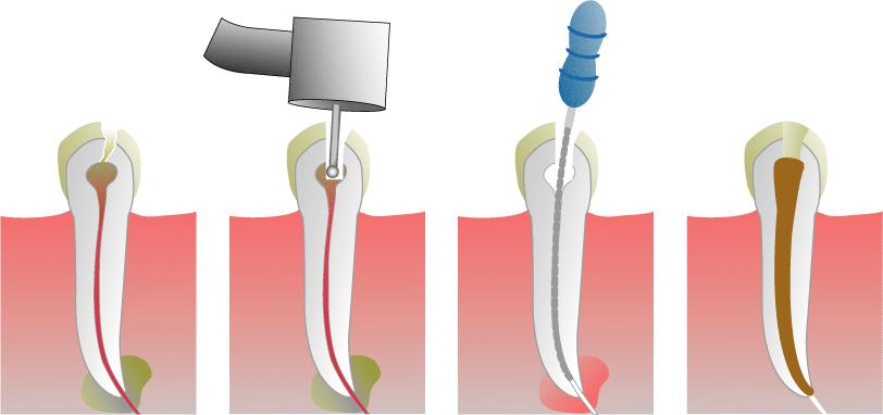 prepare for a root canal