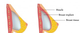 Breast Implants