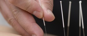 Acupuncture