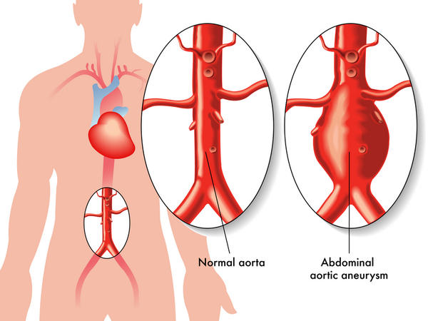 How to Treat an Aortic Aneurysm