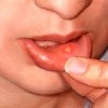 Mouth Ulcers