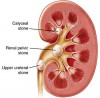 Kidney stones