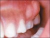 Tooth abscess