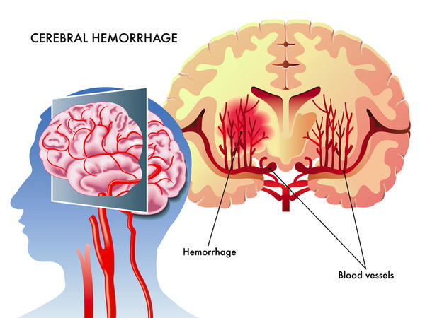 Stroke and Aneurysm