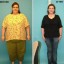 gastric bypass surgery before and after