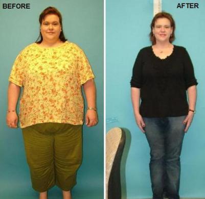 gastric bypass surgery before and after