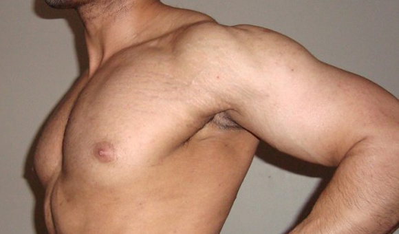 Get Rid of Stretch Marks