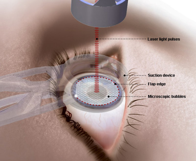 Handle Lasik Surgery