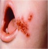 Impetigo