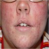 Rosacea