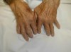 rheumatoid arthritis