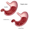 Peptic ulcer