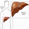 liver cirrhosis