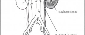 urinary stones