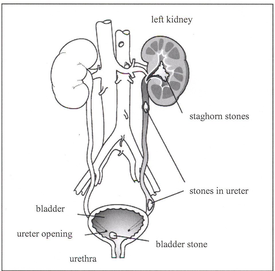 urinary stones