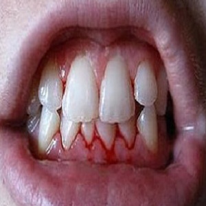 Bleeding Gums