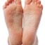 Dry Cracked Feet