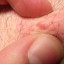 Ingrown Armpit Hair