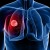 Seven Signs You Might Have Lung Cancer